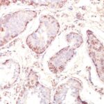 FFPE human testicular carcinoma sections stained with 100 ul anti-MAGE-1 (clone MZ2E/838) at 1:50. HIER epitope retrieval prior to staining was performed in 10mM Citrate, pH 6.0.